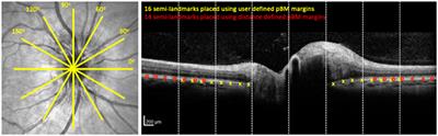 Association Between Peripapillary Bruch's Membrane Shape and Intracranial Pressure: Effect of Image Acquisition Pattern and Image Analysis Method, a Preliminary Study